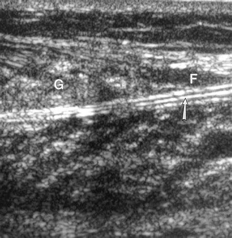 test for calf muscle tear|torn calf muscle ultrasound.